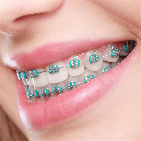 metal brackets for teeth|guys with braces on teeth.